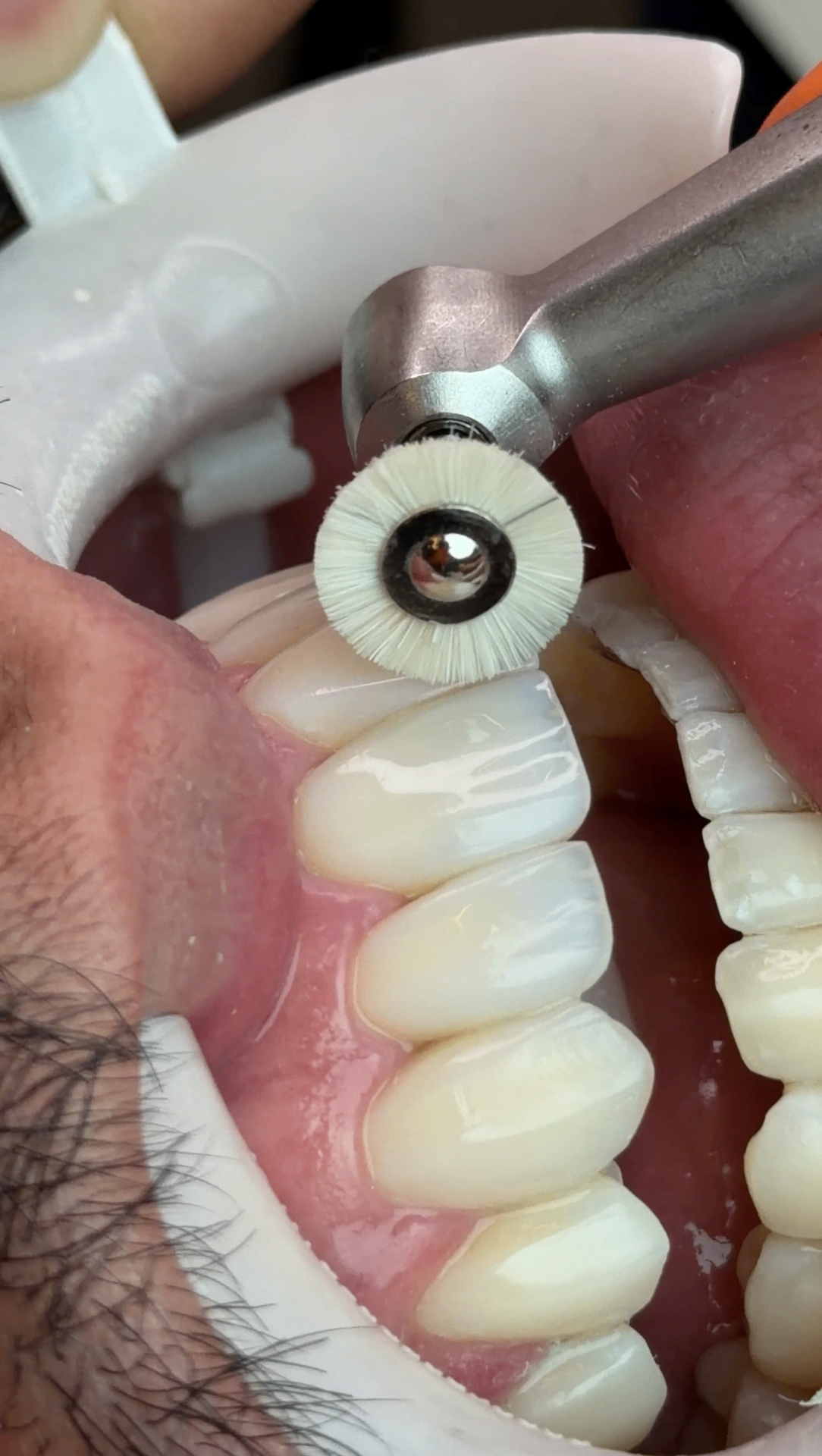 Foto clínica de escovação de brilho final no dente